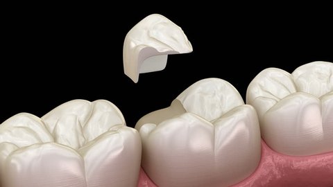 Onlay ceramic crown fixation over tooth. Medically accurate 3D animation of human teeth treatment