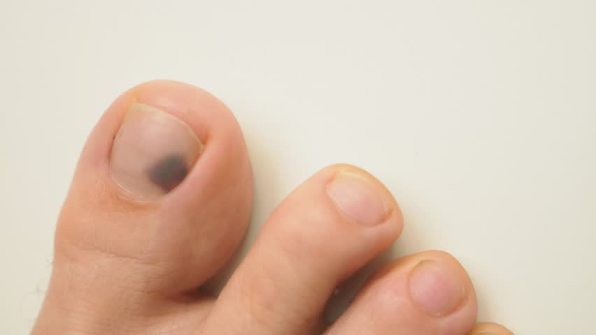 Sick nail. Trauma to the nail. Toes for legs. Bruise under the thumb nail. Trauma to the nails. Sugunal hematoma. Royalty-Free Stock Footage #1020817753
