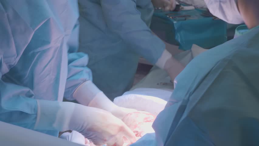 Surgical team performing surgery operation. Doctor performing surgery using sterilized equipment. Gynecologists and midwifes giving birth. Infant in maternity hospital Royalty-Free Stock Footage #1020818965
