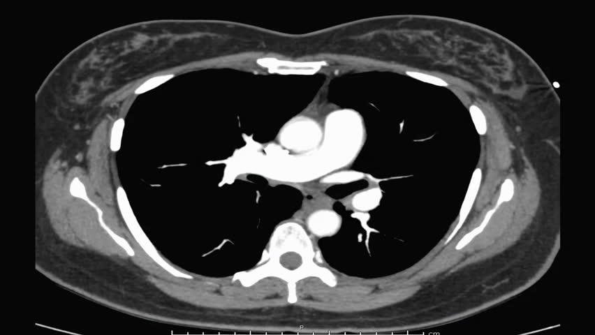 CT Chest with Contrast or CTA pulmonary artery for diagnosis pulmonary embolism and lung disease. Royalty-Free Stock Footage #1020939322