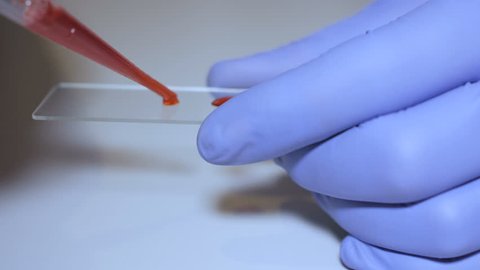 Lab technician holding pipette and testing blood samples on hospital ward for blood transfusion, hands close up. Closeup of doctor holding test tube of blood. AIDS / HIV Hospital blood test.