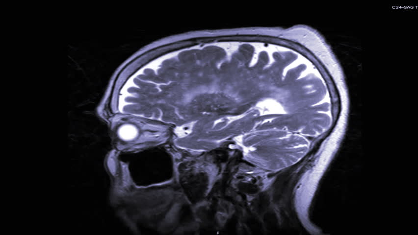 MRI of the brain can help doctors look for conditions such as bleeding, swelling, problems with the way the brain developed, tumors, infections, inflammation, damage from an injury or a stroke, or  | Shutterstock HD Video #1021086472