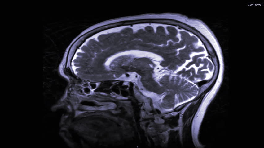 MRI of the brainMRI can help doctors look for conditions such as bleeding, swelling, problems with the way the brain developed, tumors, infections, inflammation, damage from an injury or a stroke, or  | Shutterstock HD Video #1021086472