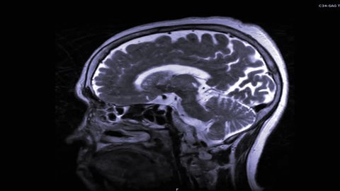 MRI of the brain in sagittal plane with contrast media. magnetic resonance imaging of the brain. 