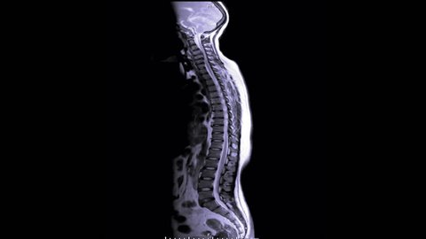 MRI Screening whole spine  showing  spine compress spinal cord ( Myelopathy )