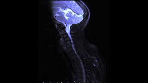 MRI of cervical spine or c-spine  showing  compression spinal cord ( Myelopathy )