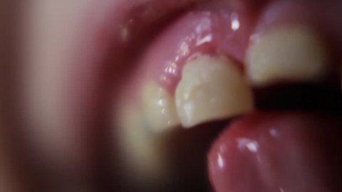 Macro Close Up Of Young Girl Wiggling Loose Front Teeth.