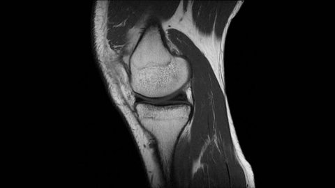 Magnetic resonance imaging of knee joint, MRI knee pain. Technique: coronal T1, sagittal T1 and axial T1 