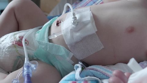 This is a video of a little 6 month old baby's G-Tube just after having surgery and getting it put in after having surgery for Organoaxial Volvulus. Shot on a GH5