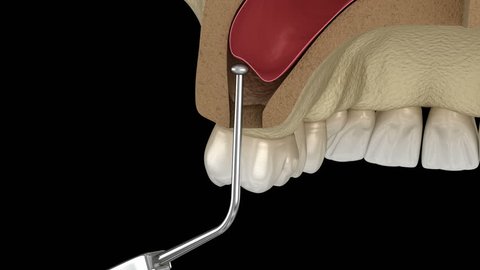 58 Maxillary Sinus Stock Video Footage - 4K and HD Video Clips | Shutterstock 58 Maxillary Sinus Stock Video Footage - 4K and HD Video Clips | Shutterstock