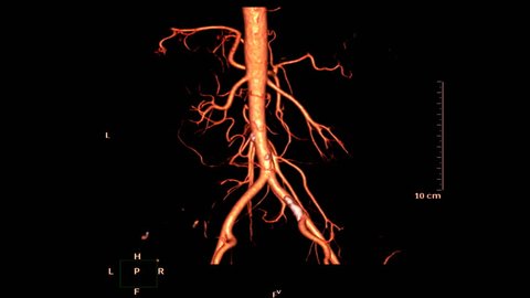 CTA abdominal aorta  or CTA renal artery 3D rendering image Turn around on the screen.