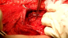 4K video on identifying and stimulating the Long Thoracic nerve during Axillary Clearance