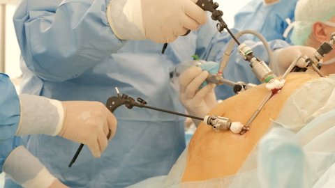 Endoscopy. Close-up. Surgeons' hands with the help of endoscopic equipment and instruments perform surgery of a fat man or a pregnant woman. A team of doctors at work. Laparoscopy. Endovideosurgery.