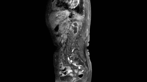 MRI OF THE LUMBOSACRAL SPINE The findings are probably TB spine as Marked reduction in height of L1 and L2 vertebral bodies, showing abnormal outline.