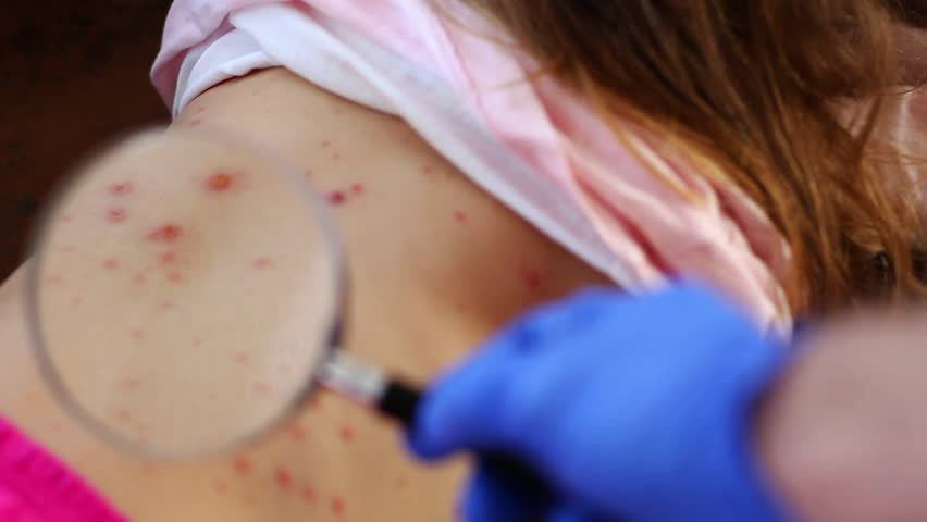 Chickenpox Rash Examination with Magnifying Glass by Doctor in Blue Gloves | Shutterstock HD Video #1023162739