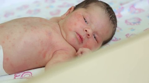 Portrait of a small newborn baby with skin Allergy in a diaper on the bed in the hospital.