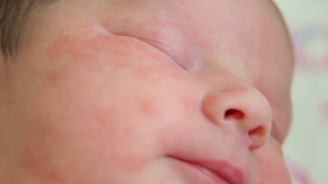 Close-up of a newborn baby with skin Allergy lying on the bed in the hospital. Close-up of a newborn baby's face with skin Allergy.