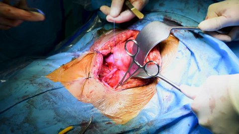 Surgery operation on liver. Kidney transplant operation 