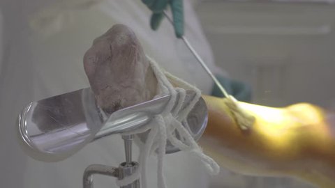 Nurse treat the patient's leg with iodine preparing to the surgery (4K, 25fps)