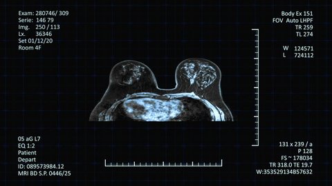 Breast Cancer Diagnosis MRI scanner. High-tech radiology mri examinations images of human body on medical screen with additional medical data