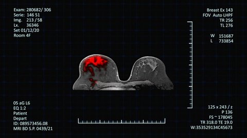MRI Scan monitor Breast Cancer Detection. High-tech radiology examinations images of female breast on medical screen with additional medical data, more options in my portfolio