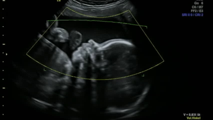 Baby Rubbing Nose and playing with Umbilical Cord in Mothers Womb -  Ultrasound Scan Gestation 3d and 4d Sonography Pregnancy Fetus check of human Embryo Fetal Echography 26 weeks second Trimester Royalty-Free Stock Footage #1023811186
