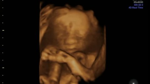 Baby Rubbing Nose and playing with Umbilical Cord in Mothers Womb -  Ultrasound Scan Gestation 3d and 4d Sonography Pregnancy Fetus check of human Embryo Fetal Echography 26 weeks second Trimester