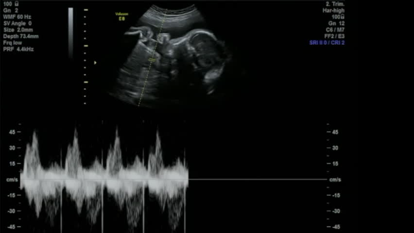 baby heartbeat sound