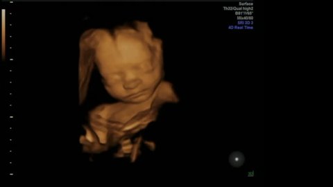 Sweet Baby Girl enjoying her peaceful Life in Mothers Womb - Ultrasound Scan Gestation 3d & 4d Sonography Pregnancy Fetus check of human Embryo Fetal Echography 26 weeks Second Trimester