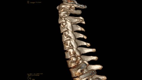 Ct Scan 3d Cervical Spine Ct Stock Footage Video (100% Royalty-free 