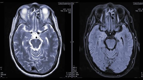 MRI brain or magnetic resonance imaging in axial view comparison T2W vs T2 Flair  showing anatomical of the brain.