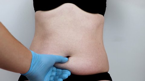 Abdominoplasty and torsoplasty: abdominal liposuction and removal of the apron. The patient at the reception at the plastic surgeon