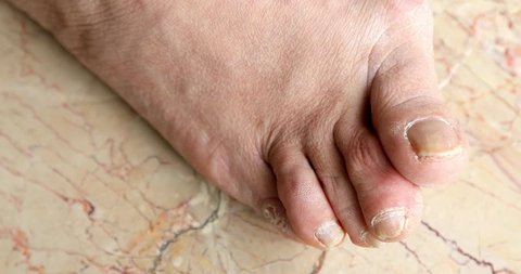 Female foots with bunion deformity