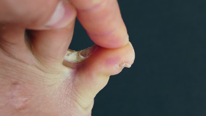 athlete-s-foot-ringworm-between-toes-fungal-vid-o-de-stock-100