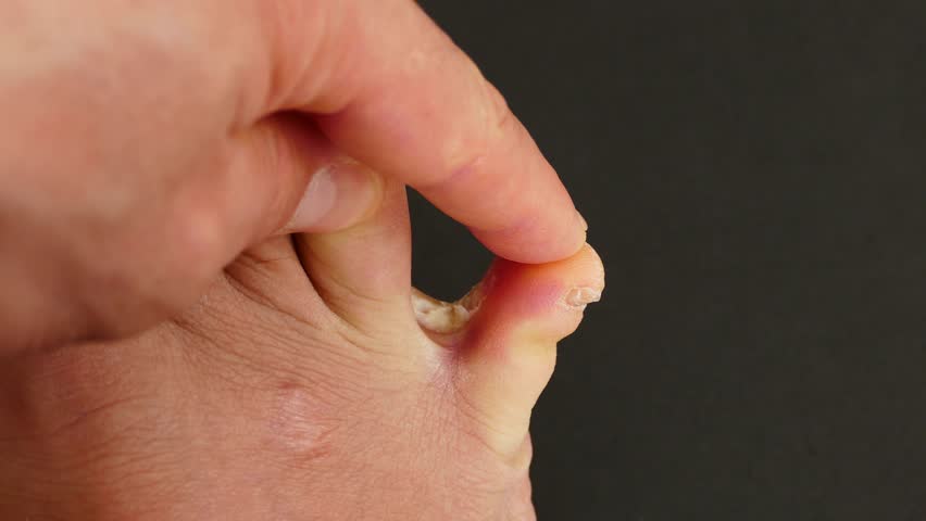 Athletes Foot Ringworm Between The Stock Footage Video 100 Royalty Free Shutterstock