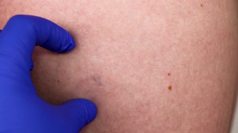 Allergic Rash Dermatitis Skin Patient Stock Photo (Edit Now) 268310828