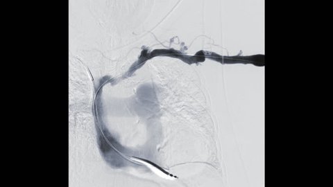 Percutaneous transluminal angioplasty or PTA  of the arteries of the arm in brachial artery with balloon.