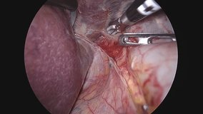 Doctors use endo-instruments and video cameras to perform surgery in the abdominal cavity of a fat woman.Modern advances in medicine.Endoscopy. 