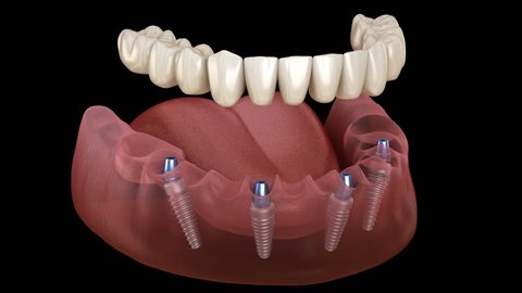 Mandibular prosthesis All on 4 system supported by implants. Medically accurate 3D animation of human teeth and dentures concept