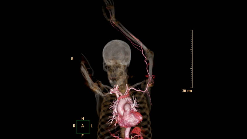 Cta Brachial Artery Ct Scan Upper Stock Footage Video 100 Royalty