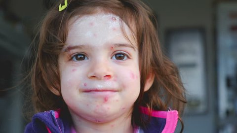 chicken pox varicella disease of child face portrait .