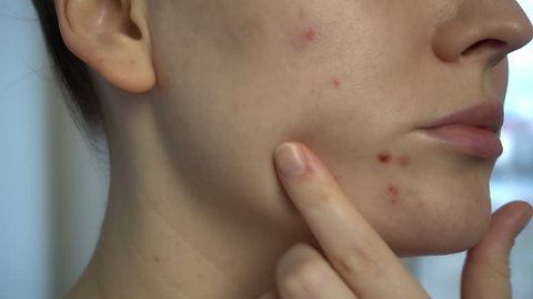 Close up of skin problems (unhealthy skin with acne and pimples).