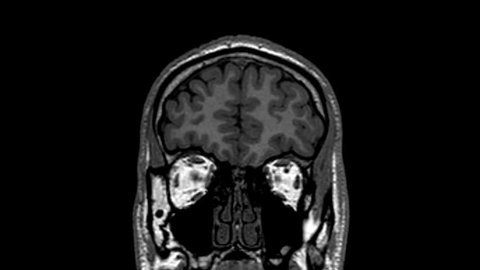 Magnetic Resonance Imaging scan from the coronal view of a human brain