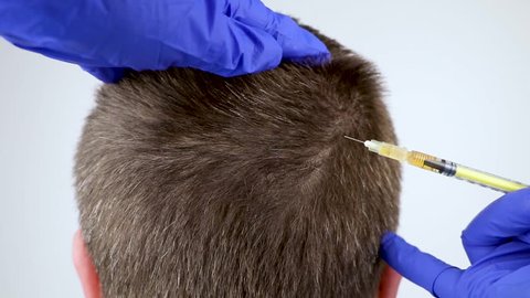 Hair mesotherapy or hair transplant: a beautician doctor makes injections in the man’s head for hair growth or to prevent baldness