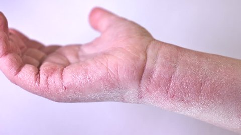 Children's atopic dermatitis. Atepic eczema on the baby’s hand close-up
