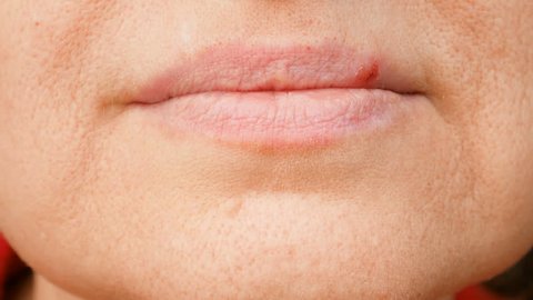 part of woman's face with herpes on  lips, herpes blisters on female lips closeup