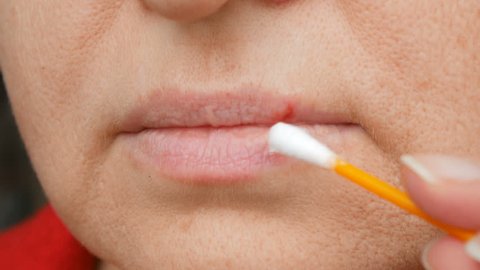 woman is treating herpes on lips by ointment, herpes blisters on female lips closeup