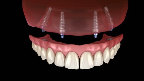 Maxillary prosthesis All on 4 system supported by implants. Medically accurate 3D animation of human teeth and dentures concept