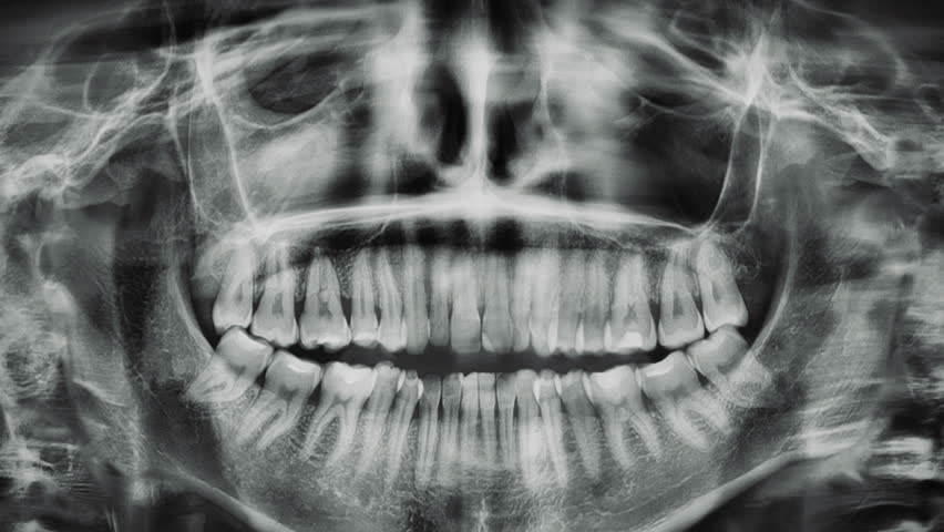 Smiling X Ray Jaw Animation Stock Footage Video 100 Royalty Free Shutterstock