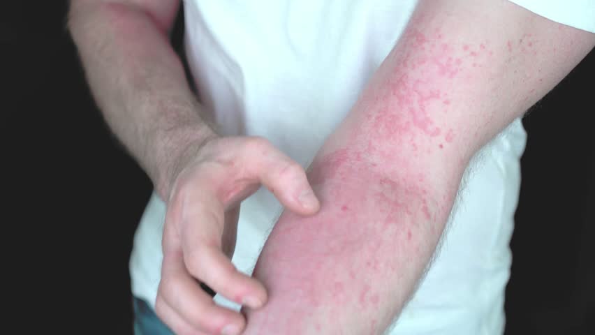 A young man notices allergic reaction rash all over the skin which is very itchy, so he scratches hard and he can not believe it and become upset, puzzled and a bit mad.  | Shutterstock HD Video #1026714728